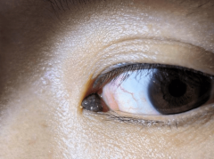 南宁爱尔眼科：眼角痣不可小觑，眼睑肿瘤或悄然来袭！